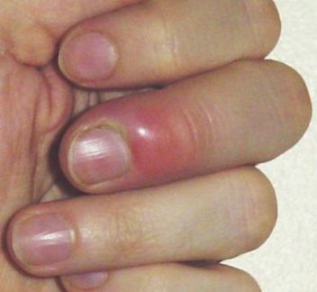 How To Treat And Prevent Fingernail Infection West Oaks Urgent Care Center Blog